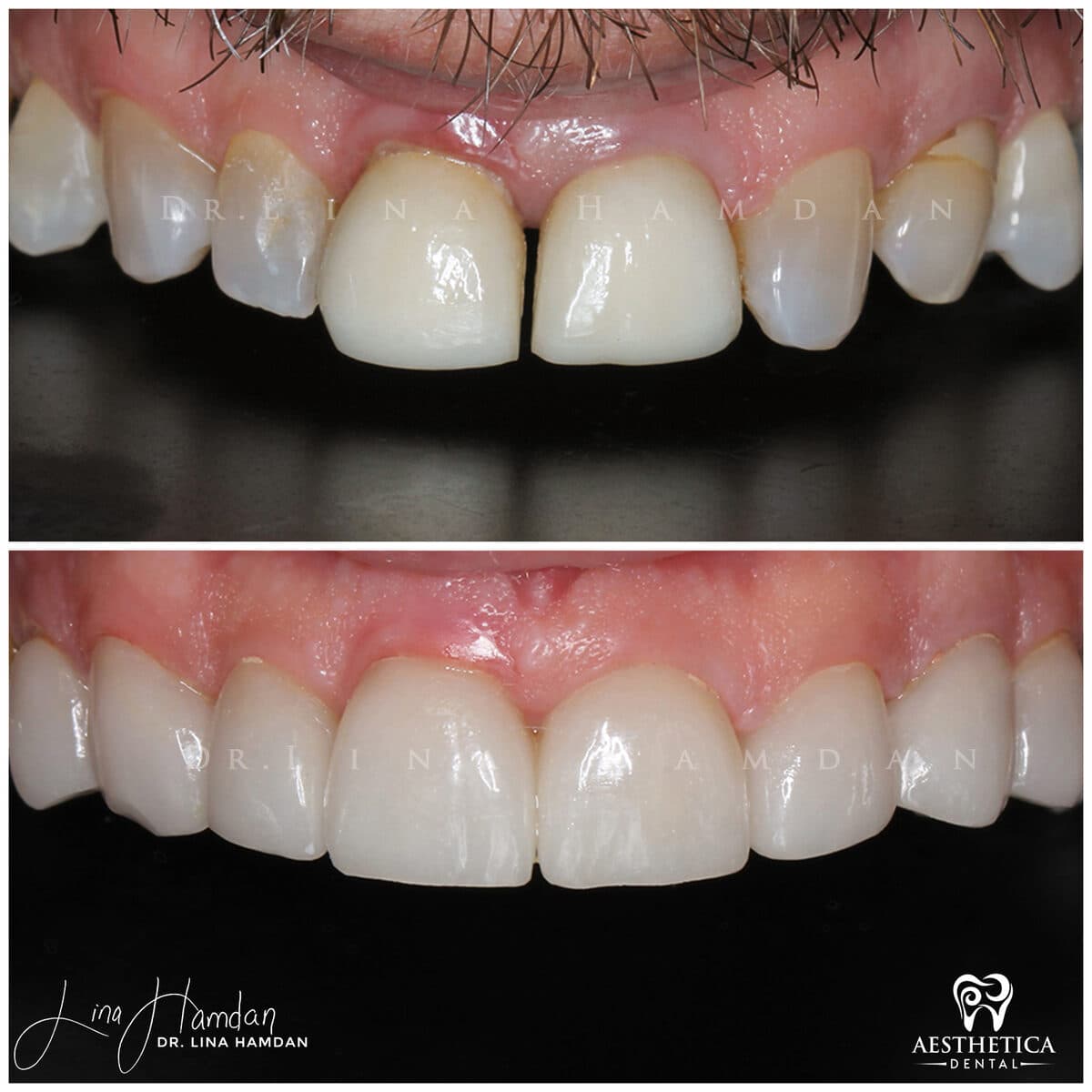 Considered porcelain veneers: anonymous case 58 from Aesthetica Dental Naperville