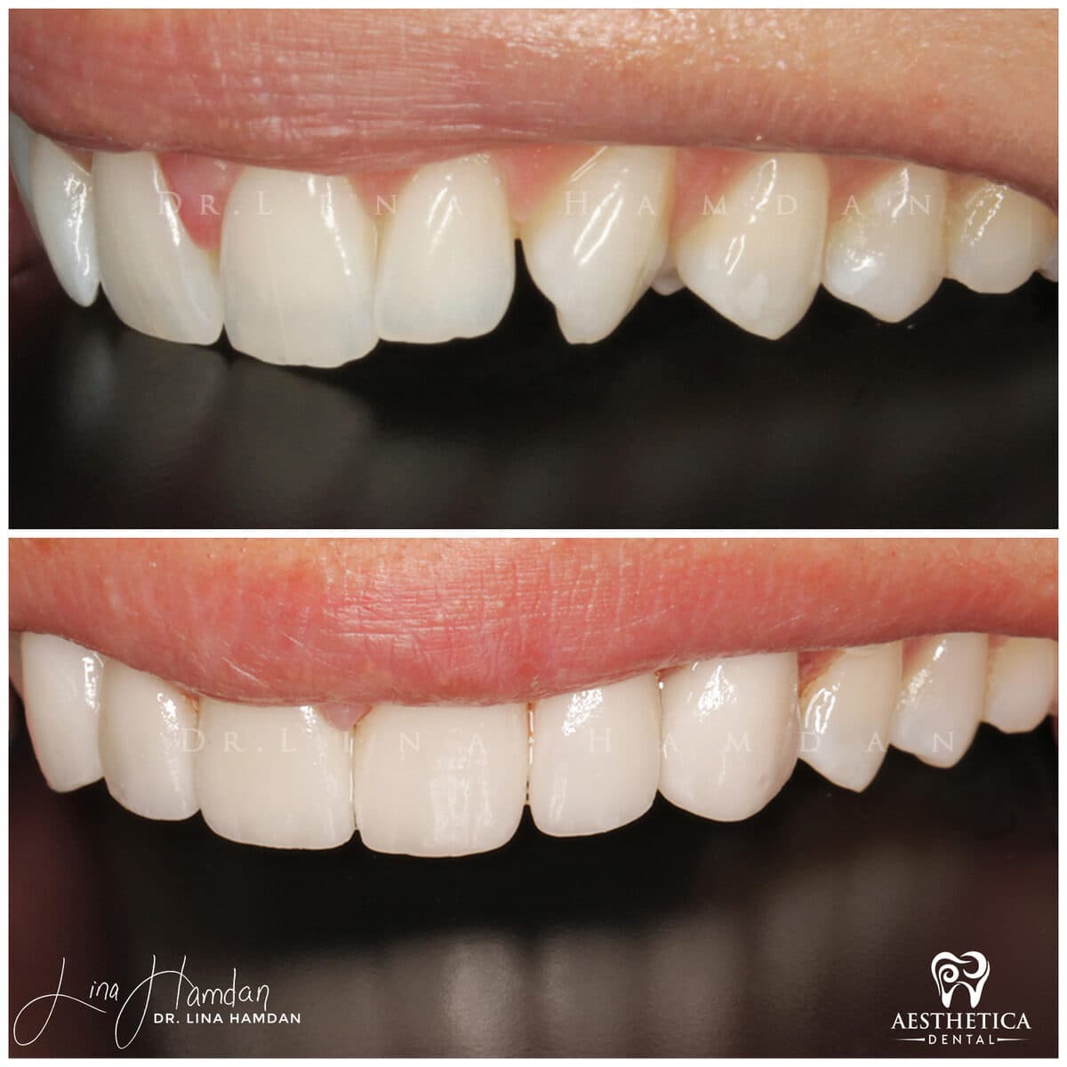 Considered porcelain veneers: anonymous case 59 from Aesthetica Dental Naperville