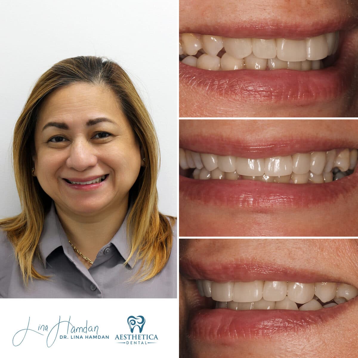 Considered porcelain veneers: anonymous case 61 from Aesthetica Dental Naperville