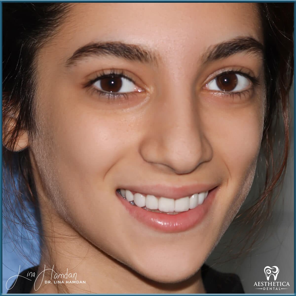 Considered porcelain veneers: anonymous case 68 from Aesthetica Dental Naperville