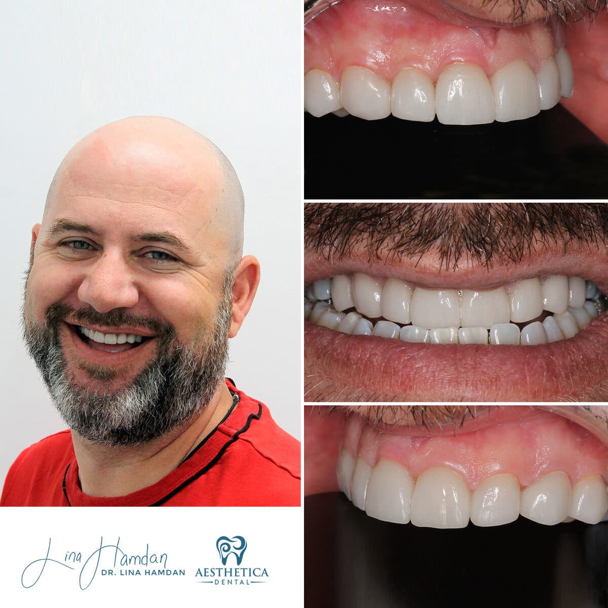 Considered porcelain veneers: anonymous case 71 from Aesthetica Dental Naperville