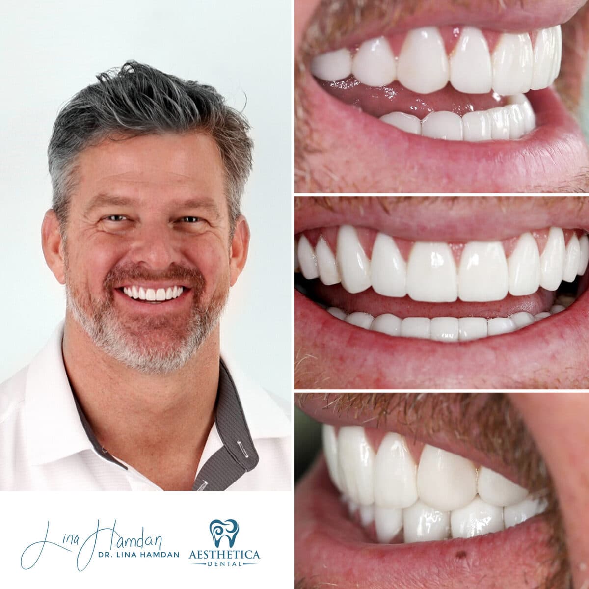 Considered porcelain veneers: anonymous case 72 from Aesthetica Dental Naperville