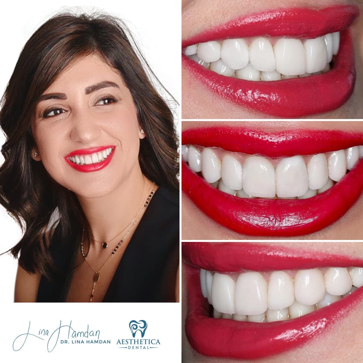 Considered porcelain veneers: anonymous case 73 from Aesthetica Dental Naperville
