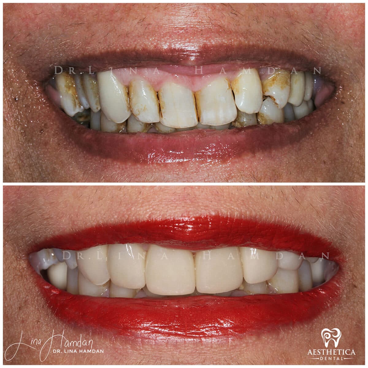 Considered porcelain veneers: anonymous case 77 from Aesthetica Dental Naperville