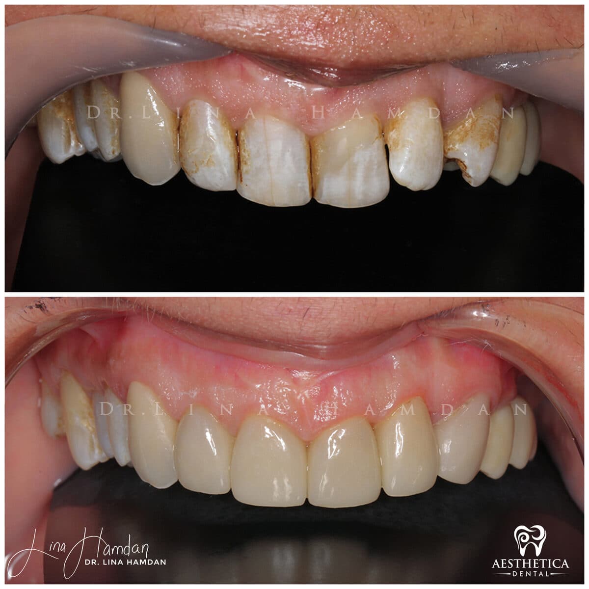Considered porcelain veneers: anonymous case 78 from Aesthetica Dental Naperville