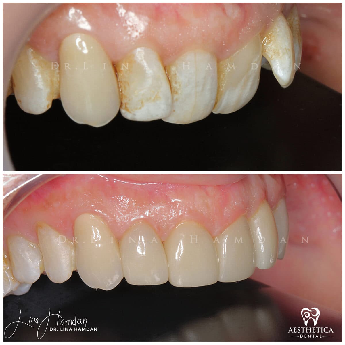 Considered porcelain veneers: anonymous case 79 from Aesthetica Dental Naperville