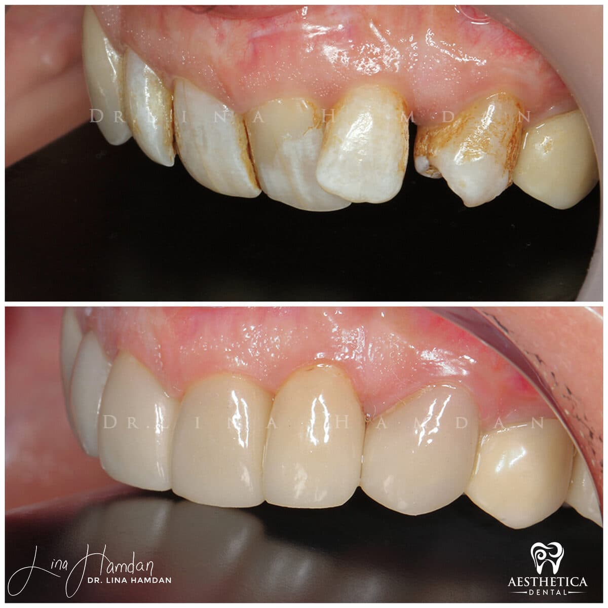 Considered porcelain veneers: anonymous case 80 from Aesthetica Dental Naperville