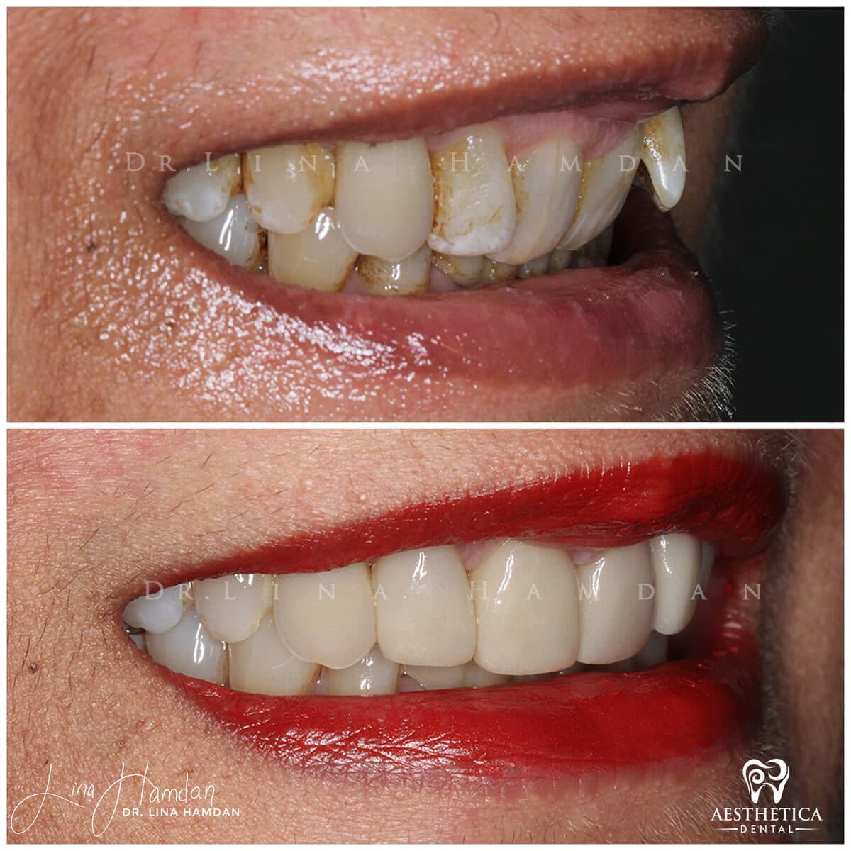 Considered porcelain veneers: anonymous case 82 from Aesthetica Dental Naperville