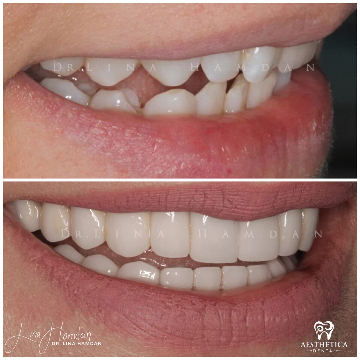 Considered porcelain veneers: anonymous case 83 from Aesthetica Dental Naperville