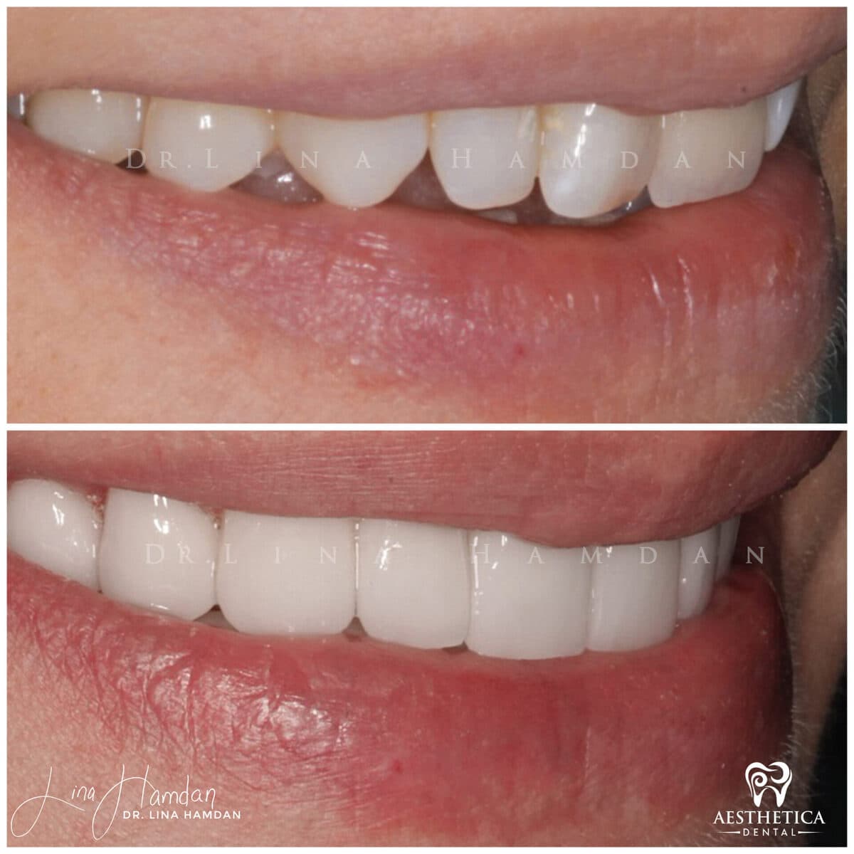 Considered porcelain veneers: anonymous case 85 from Aesthetica Dental Naperville