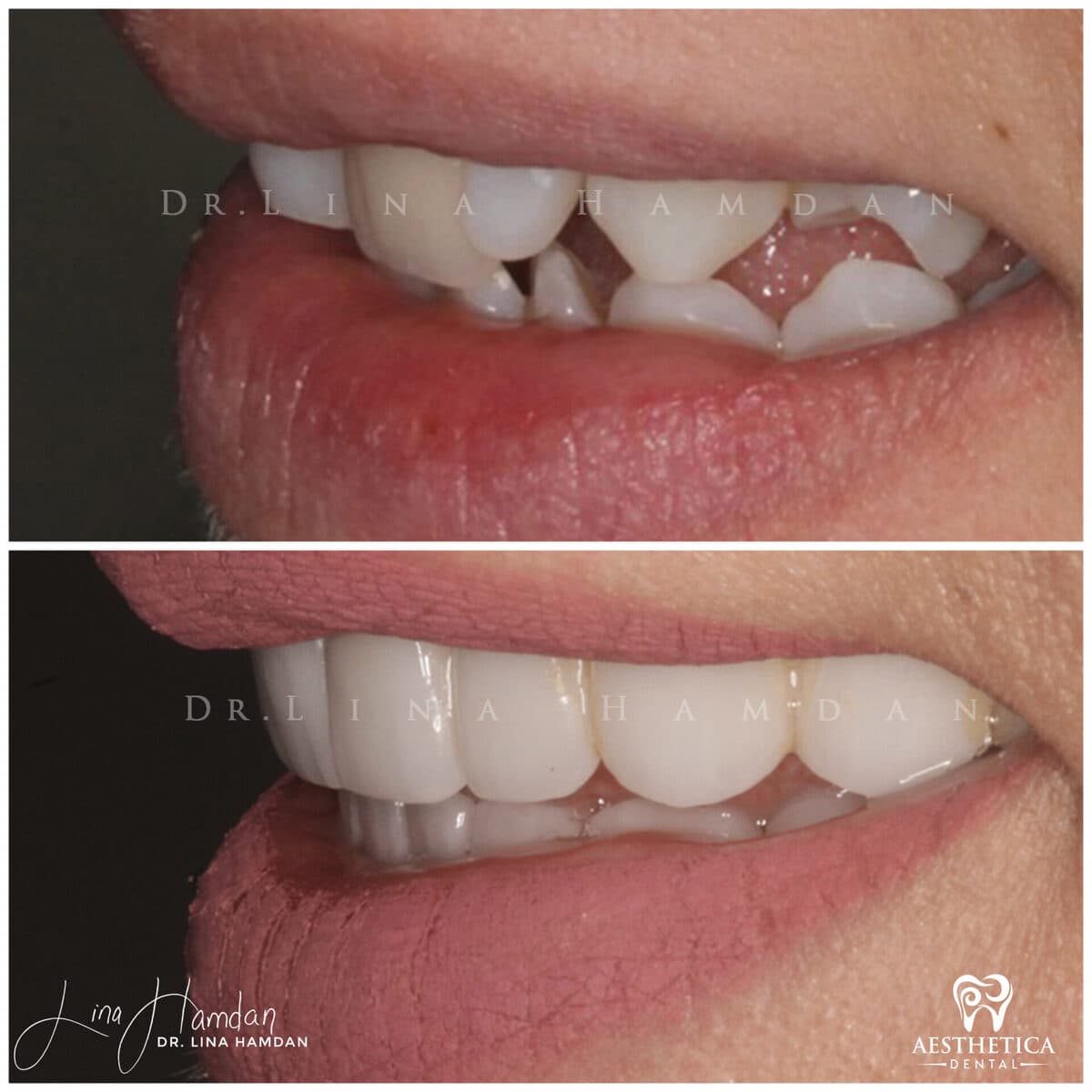 Considered porcelain veneers: anonymous case 86 from Aesthetica Dental Naperville