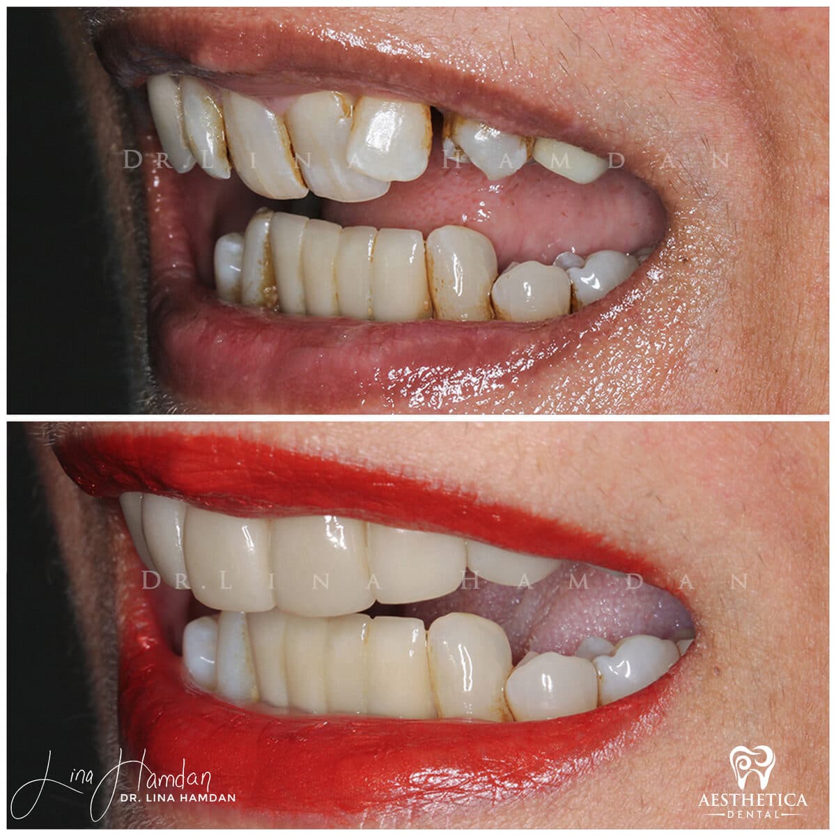 Considered porcelain veneers: anonymous case 87 from Aesthetica Dental Naperville