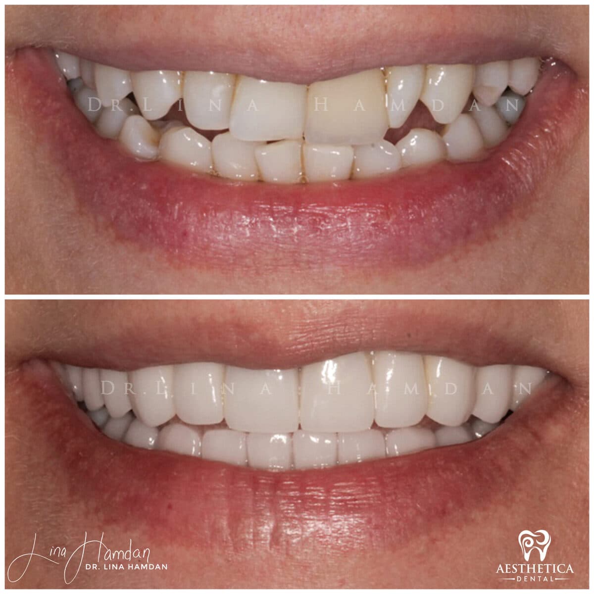 Considered porcelain veneers: anonymous case 89 from Aesthetica Dental Naperville