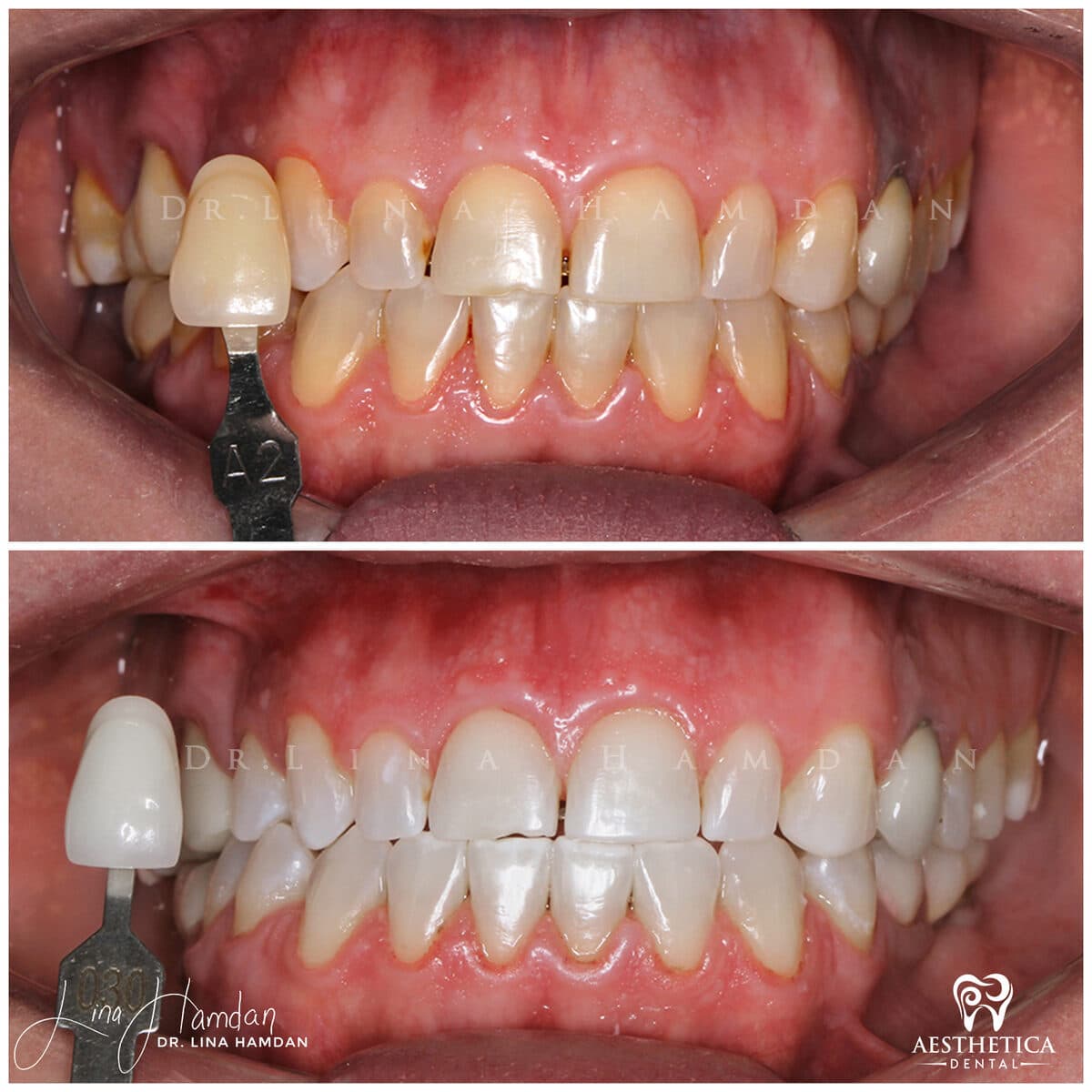 Teeth whitening.: anonymous before-and-after case photograph from Aesthetica Dental Naperville