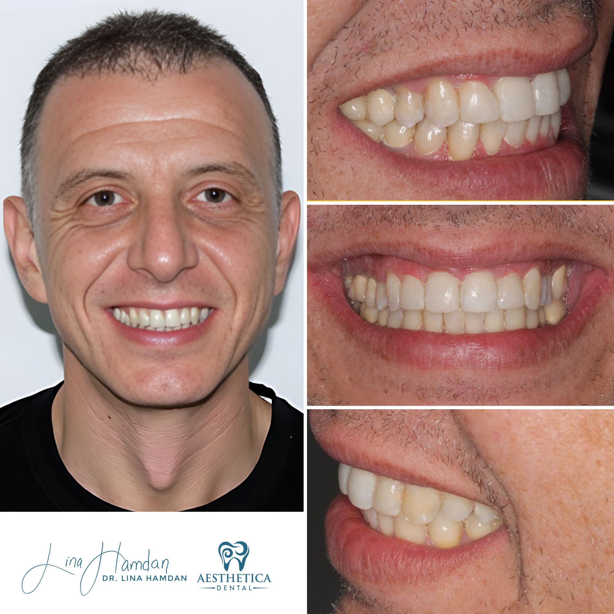 Porcelain veneers result, upper arch, anonymous patient at Aesthetica Dental Naperville