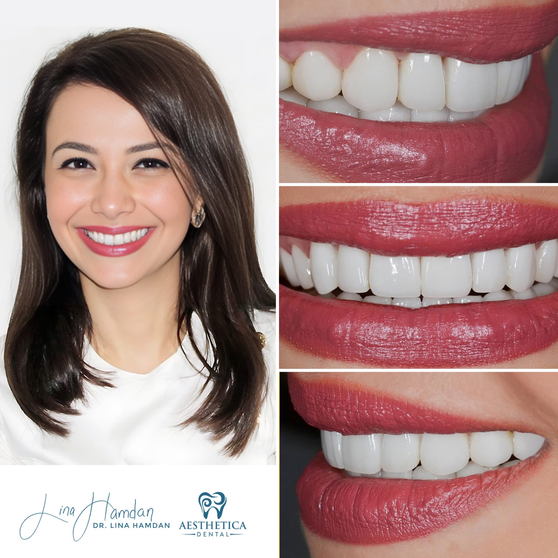 Smile makeover combining veneers and whitening, anonymous patient at Aesthetica Dental Naperville