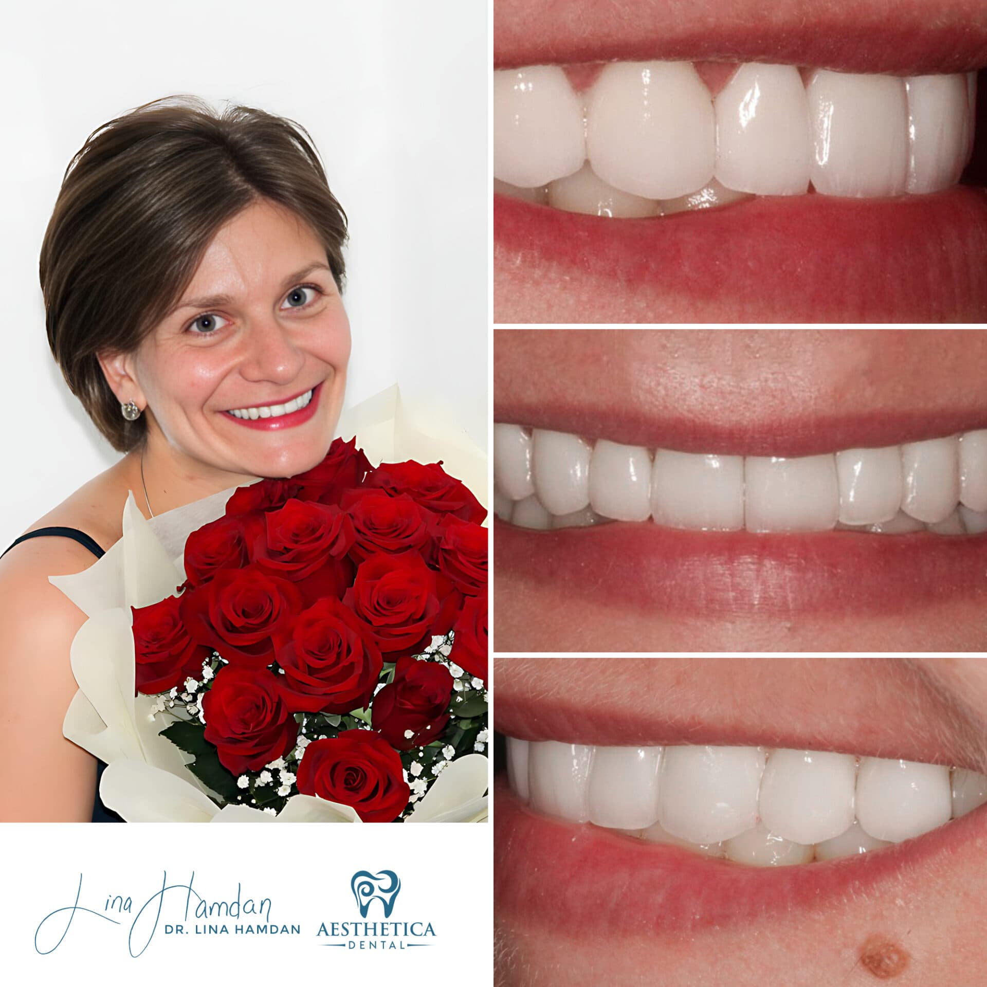Porcelain veneers result, lateral incisor reshaping, anonymous patient at Aesthetica Dental Naperville