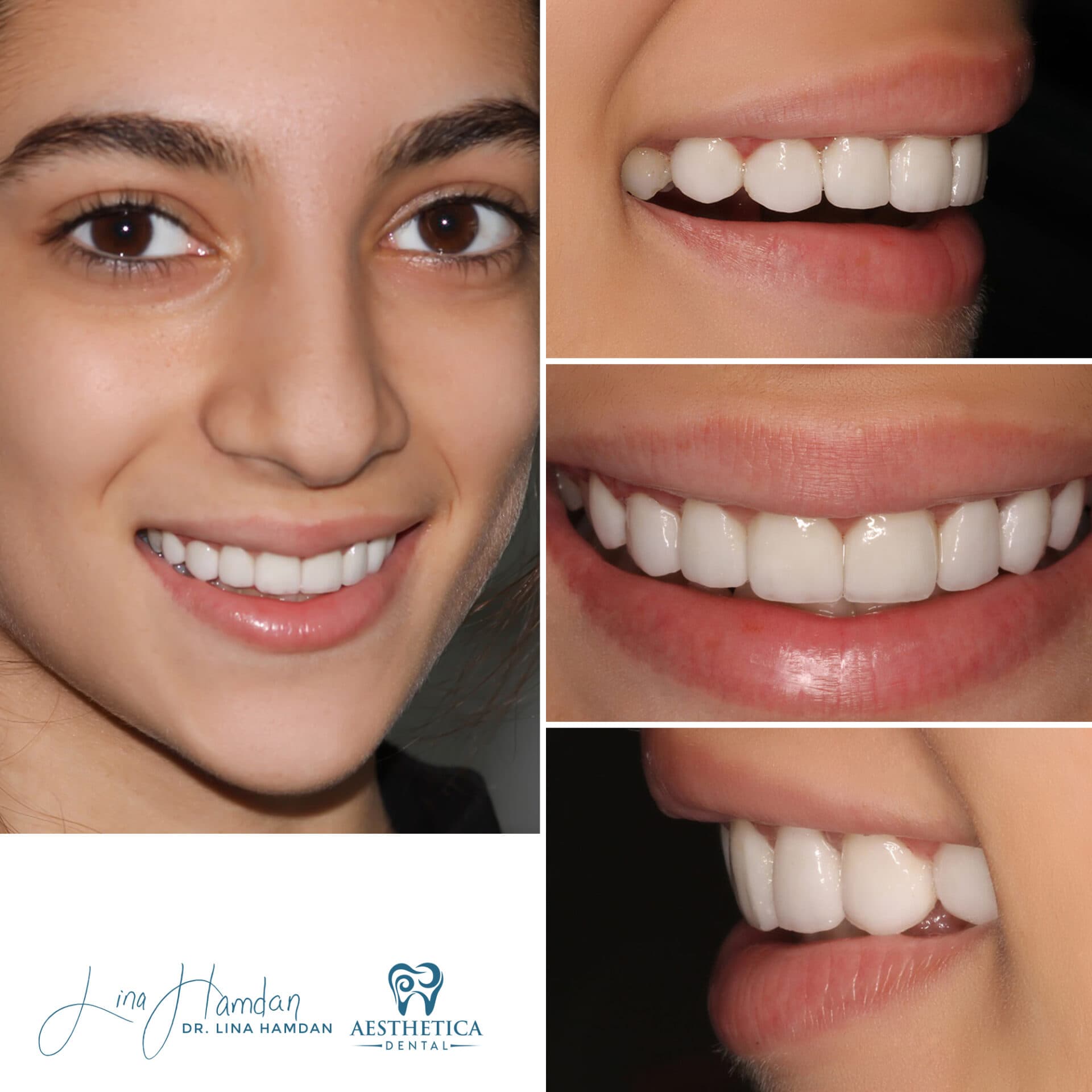 Porcelain veneers result, six-unit anterior case, anonymous patient at Aesthetica Dental Naperville