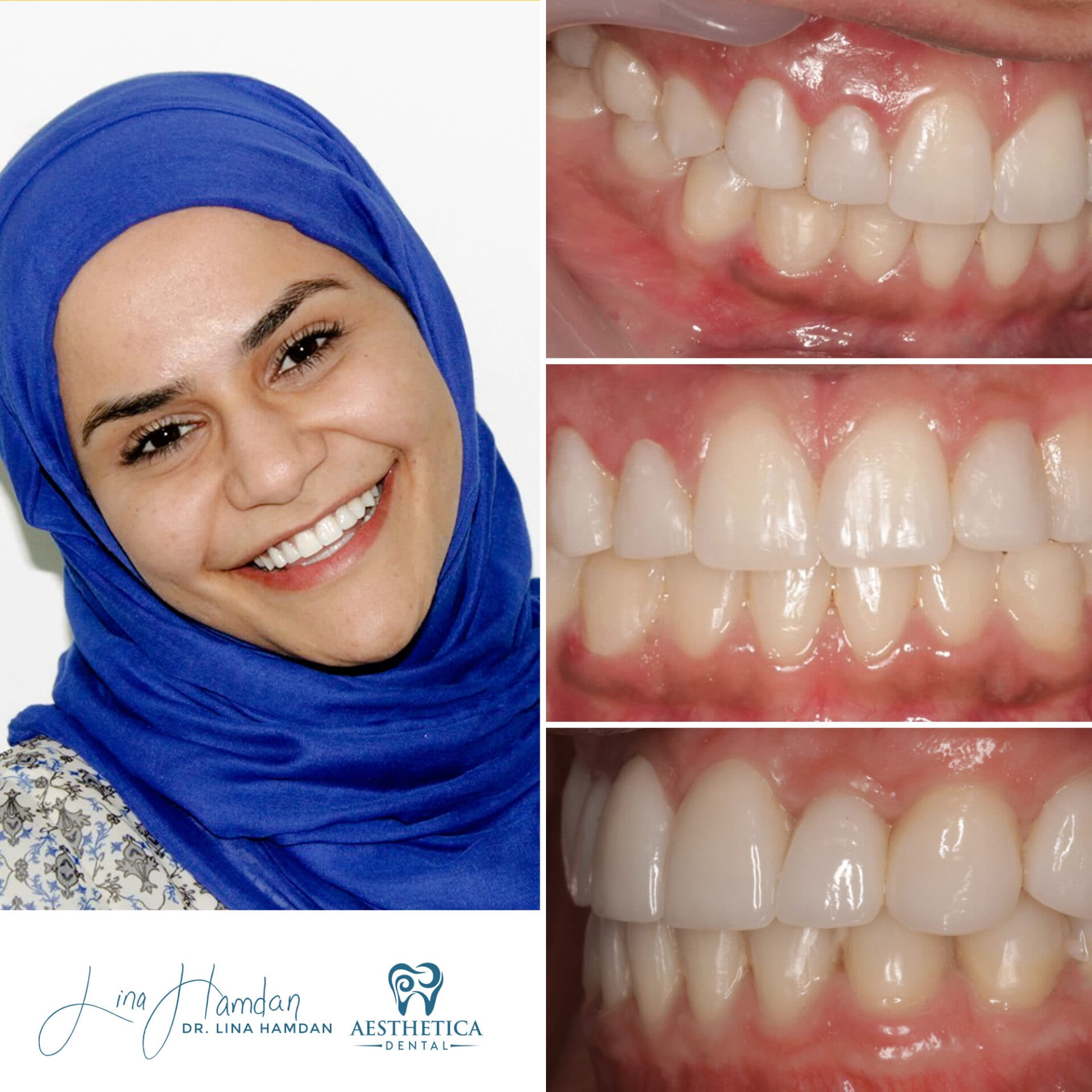 Teeth whitening result, in-office Zoom® session, anonymous patient at Aesthetica Dental Naperville