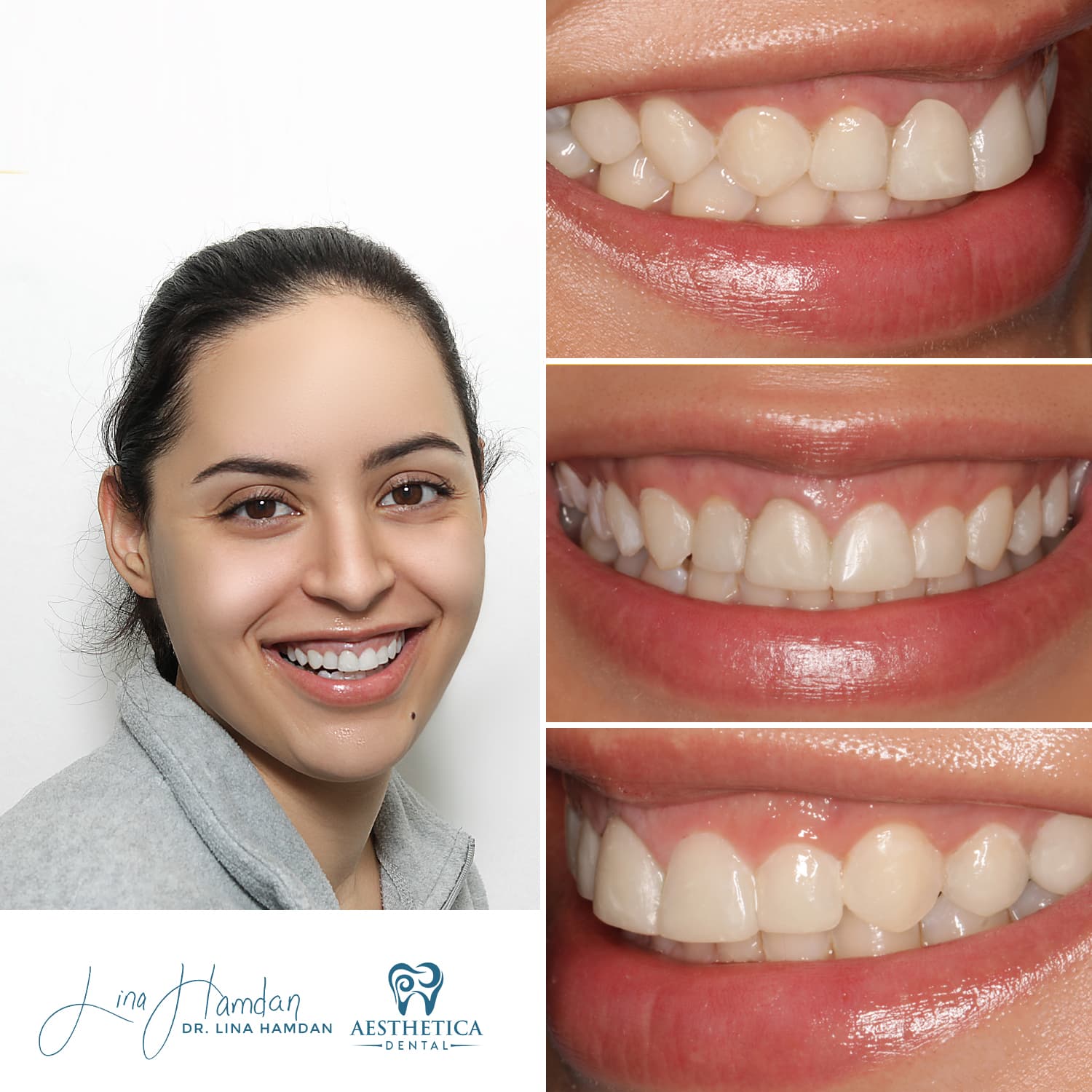 Smile makeover including periodontal treatment, anonymous patient at Aesthetica Dental Naperville
