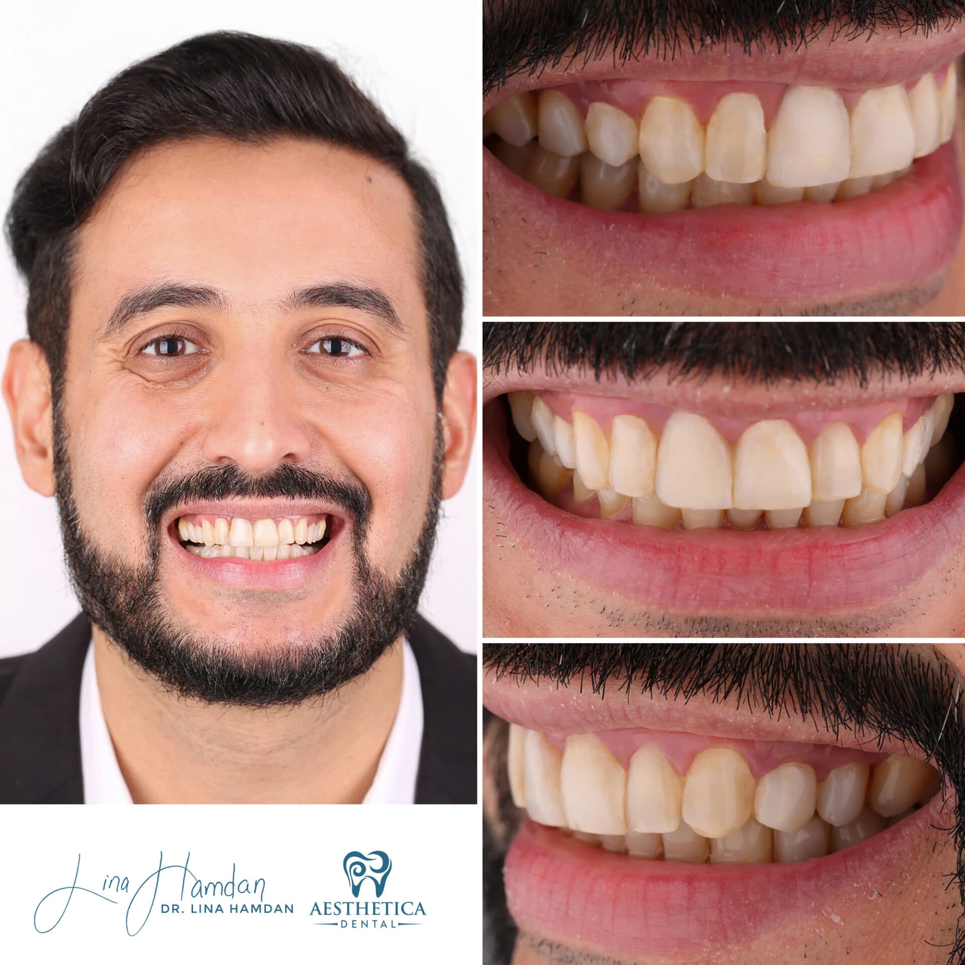 Composite bonding result, central diastema closure, anonymous patient at Aesthetica Dental Naperville