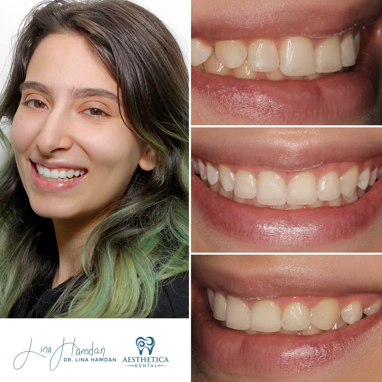 Porcelain veneers result, full upper arch, anonymous patient at Aesthetica Dental Naperville