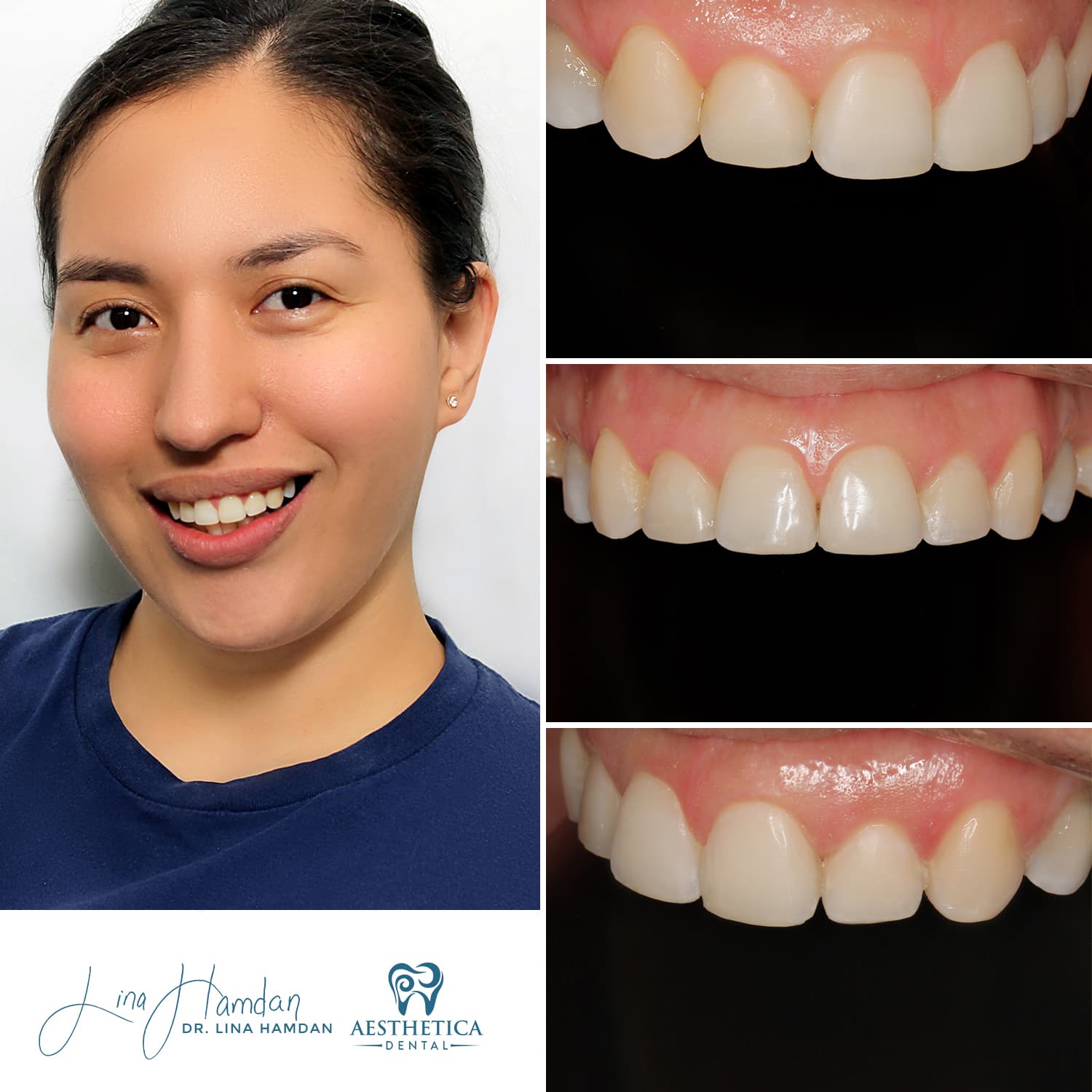 Smile makeover combining bonding and whitening, anonymous patient at Aesthetica Dental Naperville