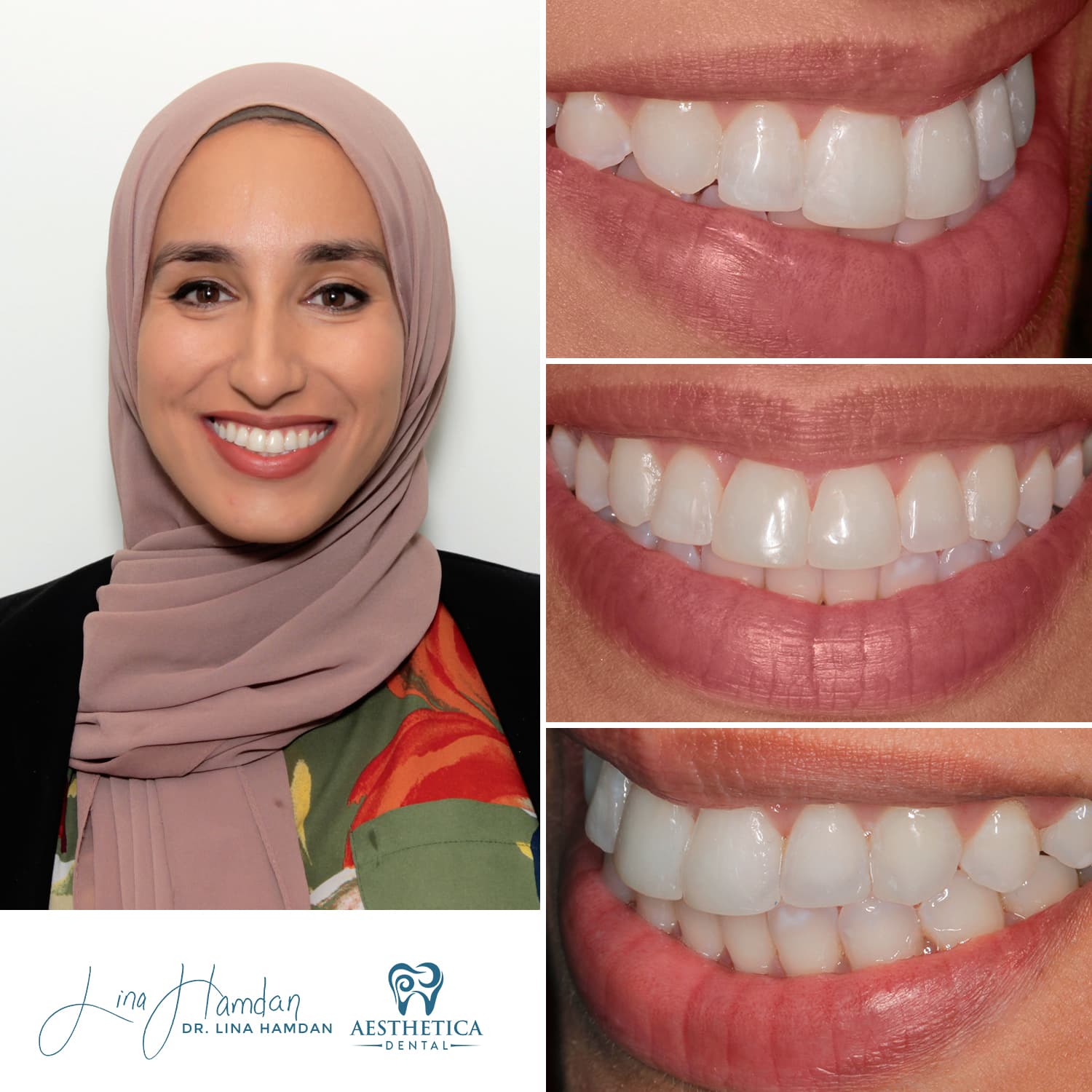 Inman Aligner result, lower arch alignment, anonymous patient at Aesthetica Dental Naperville