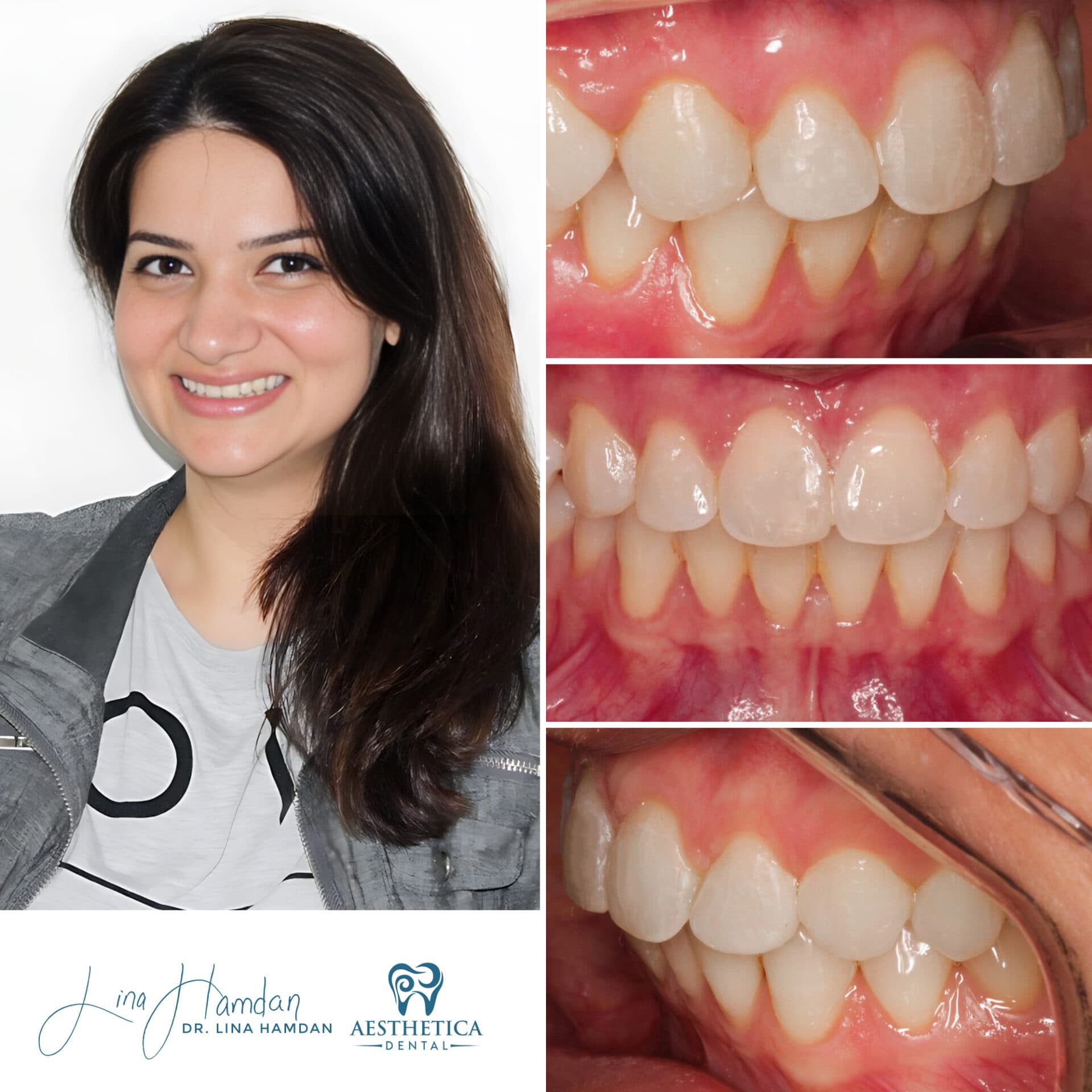 Teeth whitening result with custom take-home trays, anonymous patient at Aesthetica Dental Naperville