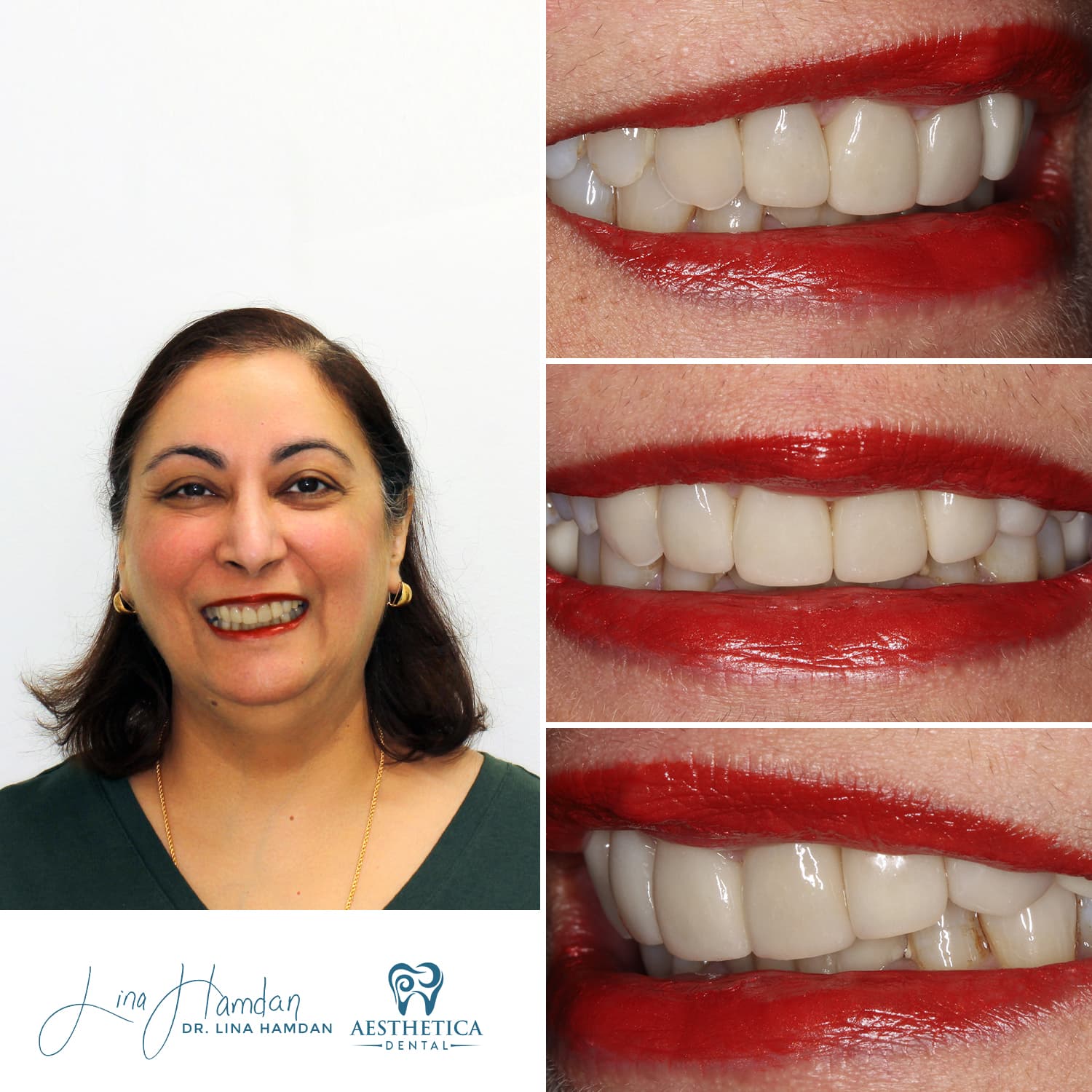 Porcelain veneers result, anterior teeth, anonymous patient at Aesthetica Dental Naperville