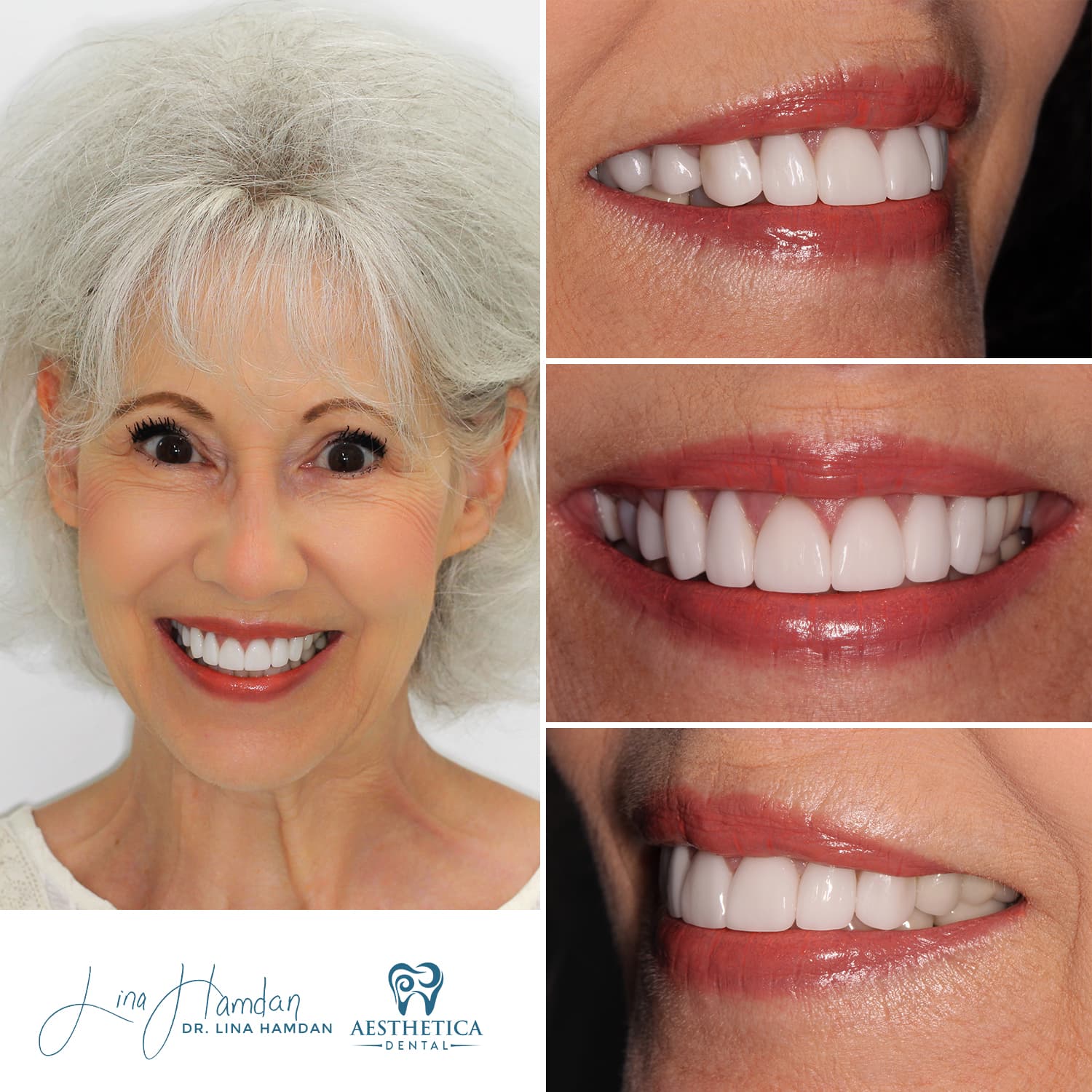 Smile makeover with porcelain veneers, anonymous patient at Aesthetica Dental Naperville