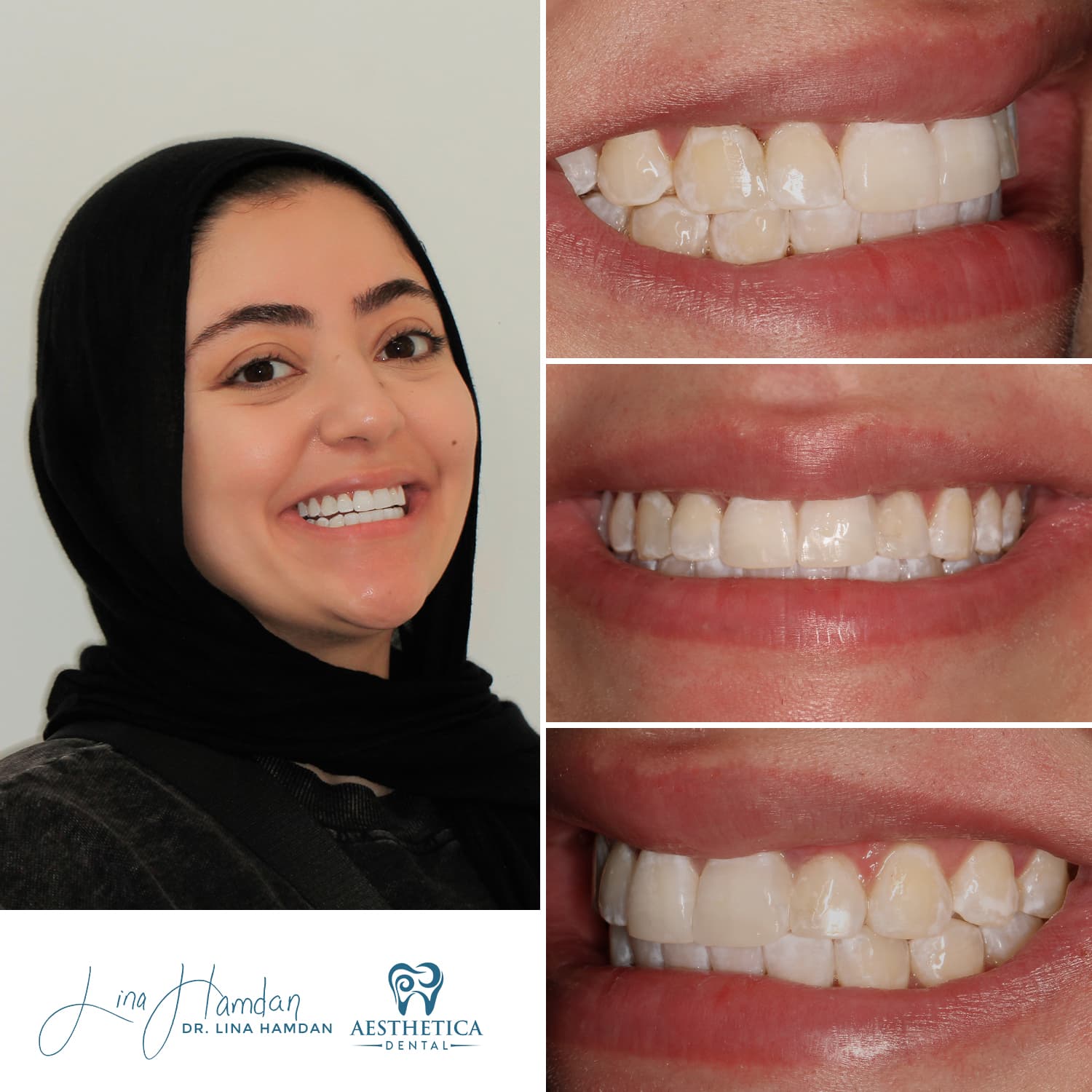 Cosmetic dentistry smile transformation, anonymous patient at Aesthetica Dental Naperville