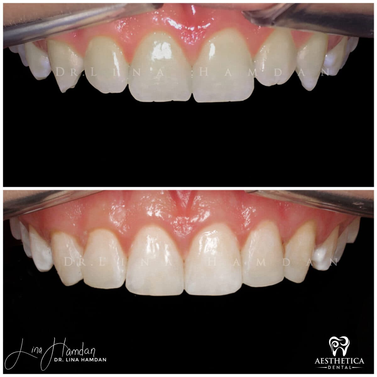 Composite bonding result, anonymous patient at Aesthetica Dental Naperville (case 4, 2025-01-1-46)