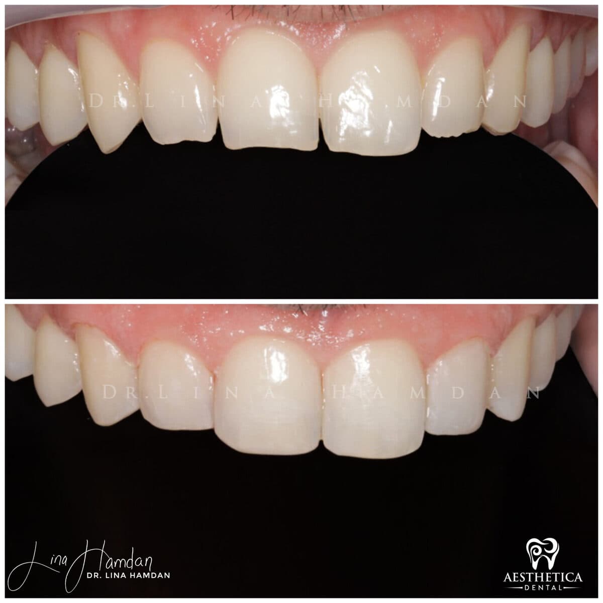 Composite bonding result, anonymous patient at Aesthetica Dental Naperville (case 5, 2025-01-1-47)