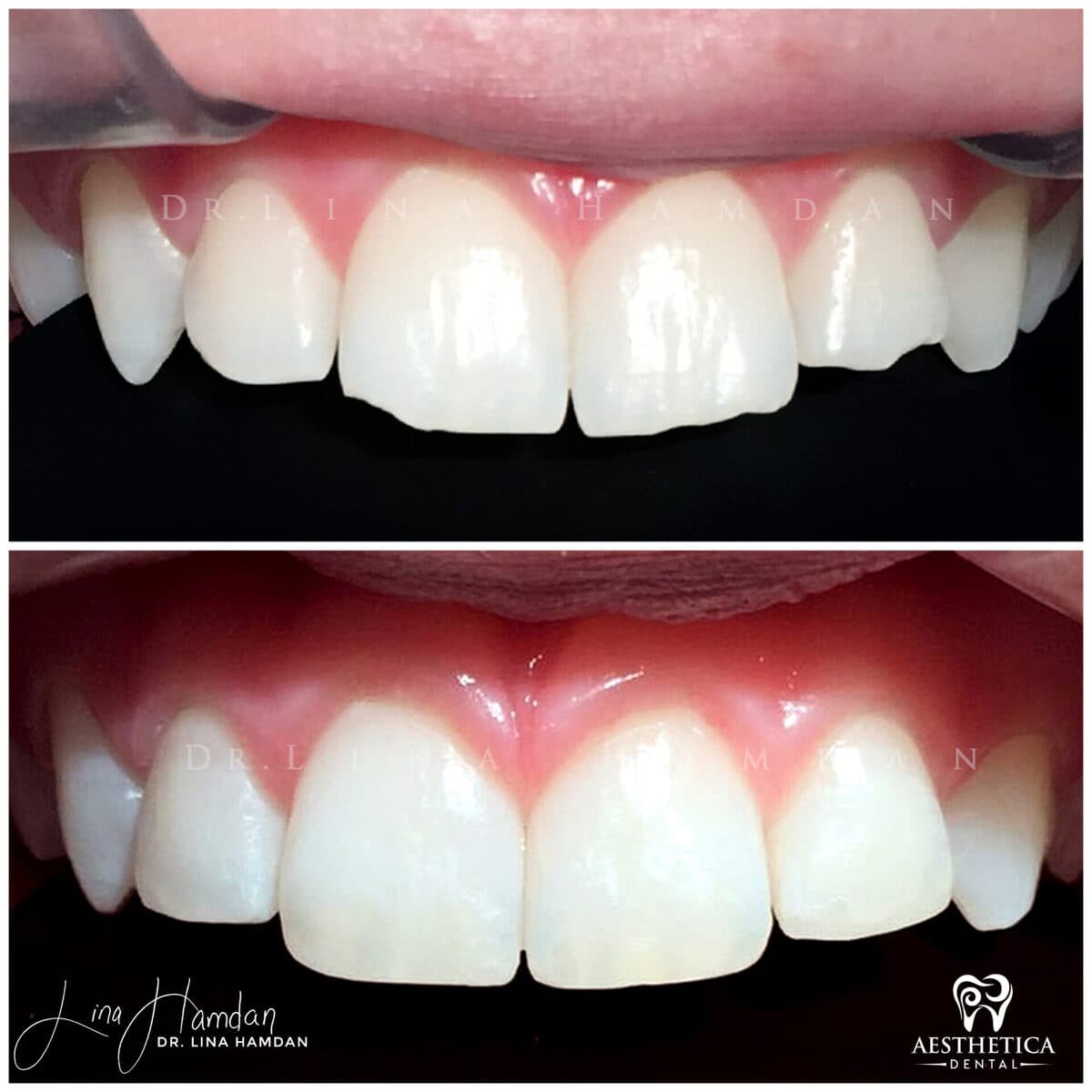 Composite bonding result, anonymous patient at Aesthetica Dental Naperville (case 6, 2025-01-1-48)