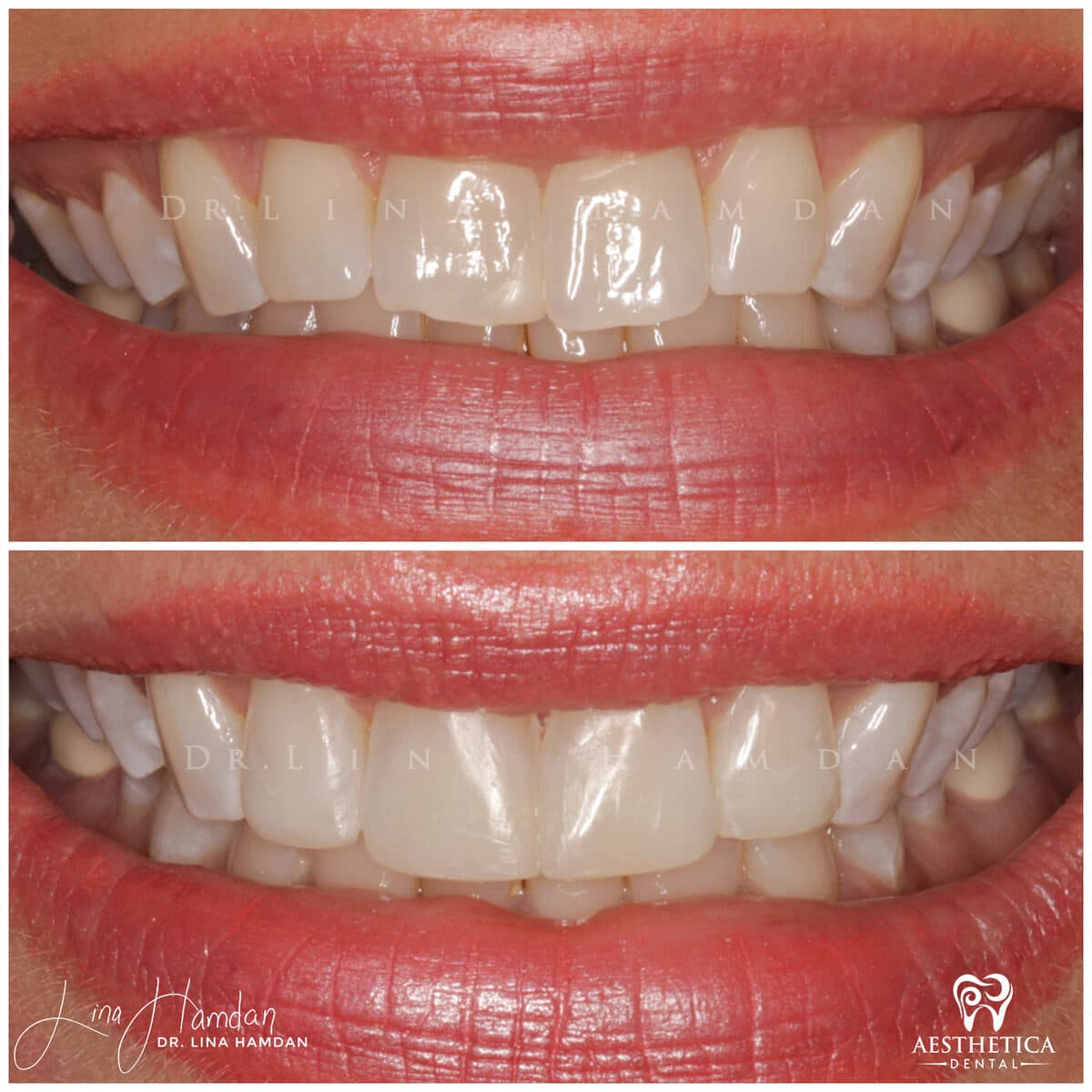 Composite bonding result, anonymous patient at Aesthetica Dental Naperville (case 7, 2025-01-1-49)