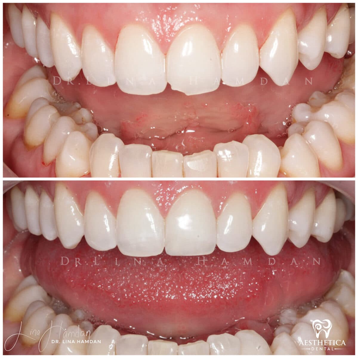 Composite bonding result, anonymous patient at Aesthetica Dental Naperville (case 9, 2025-01-1-51)