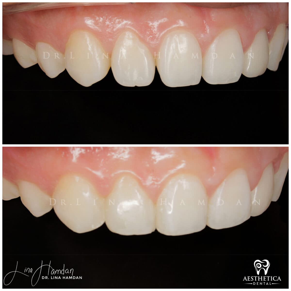 Composite bonding result, anonymous patient at Aesthetica Dental Naperville (case 11, 2025-01-1-53)