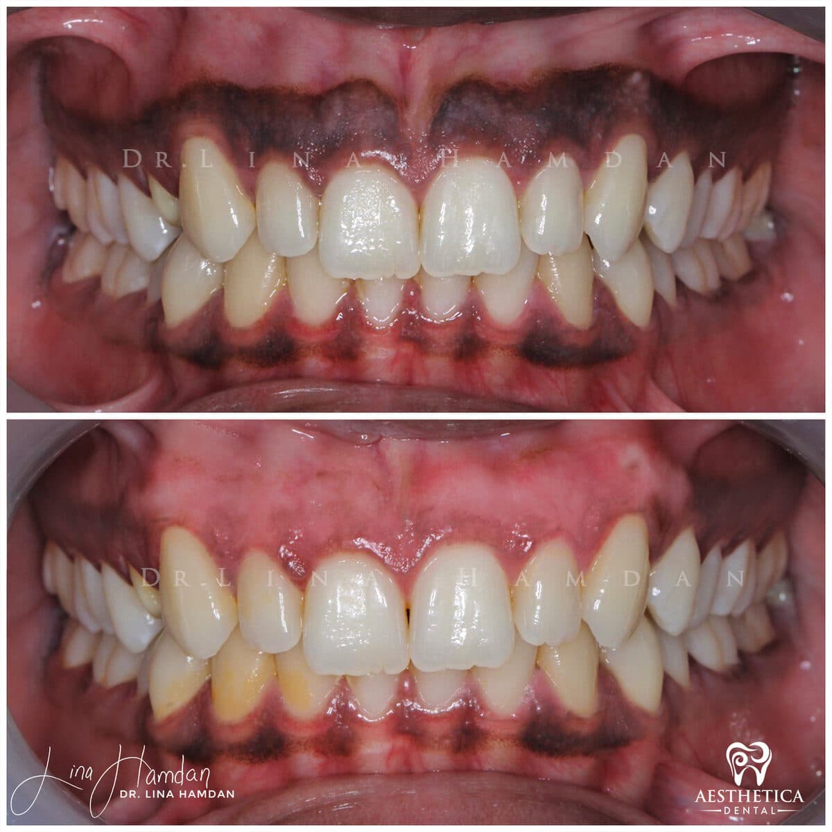 Gum Depigmentation: patient result by Dr. Lina Hamdan