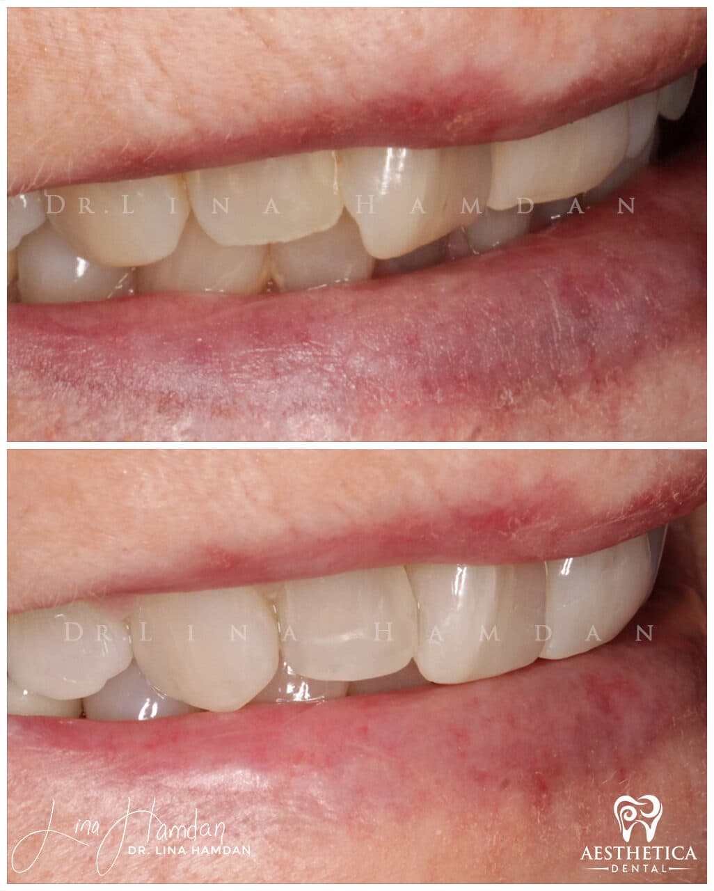 Inman Aligner result, anonymous patient at Aesthetica Dental Naperville (case 2, 2025-01-1-63)