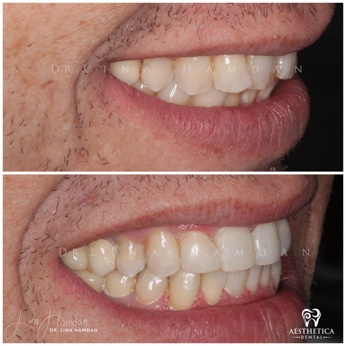 Inman Aligner result, anonymous patient at Aesthetica Dental Naperville (case 3, 2025-01-1-64)