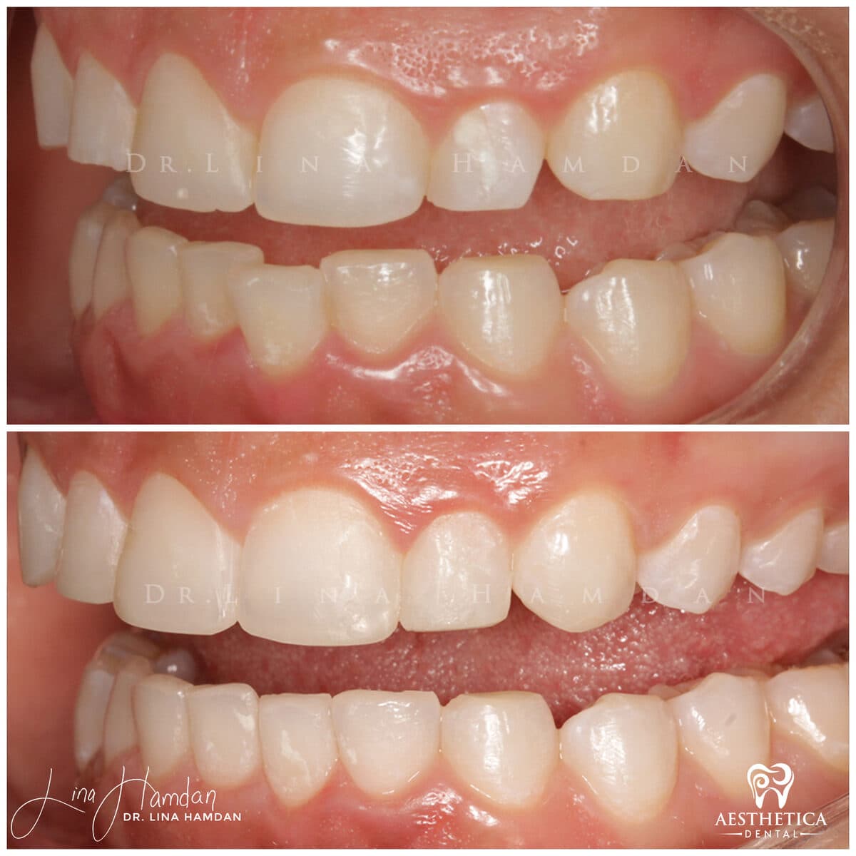 Inman Aligner result, anonymous patient at Aesthetica Dental Naperville (case 7, 2025-01-10-12)