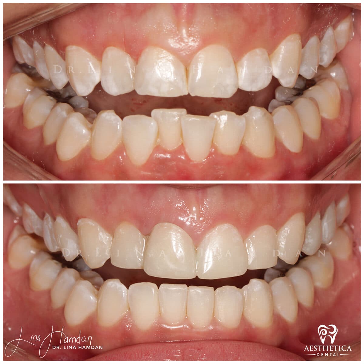 Inman Aligner result, anonymous patient at Aesthetica Dental Naperville (case 10, 2025-01-10-15)