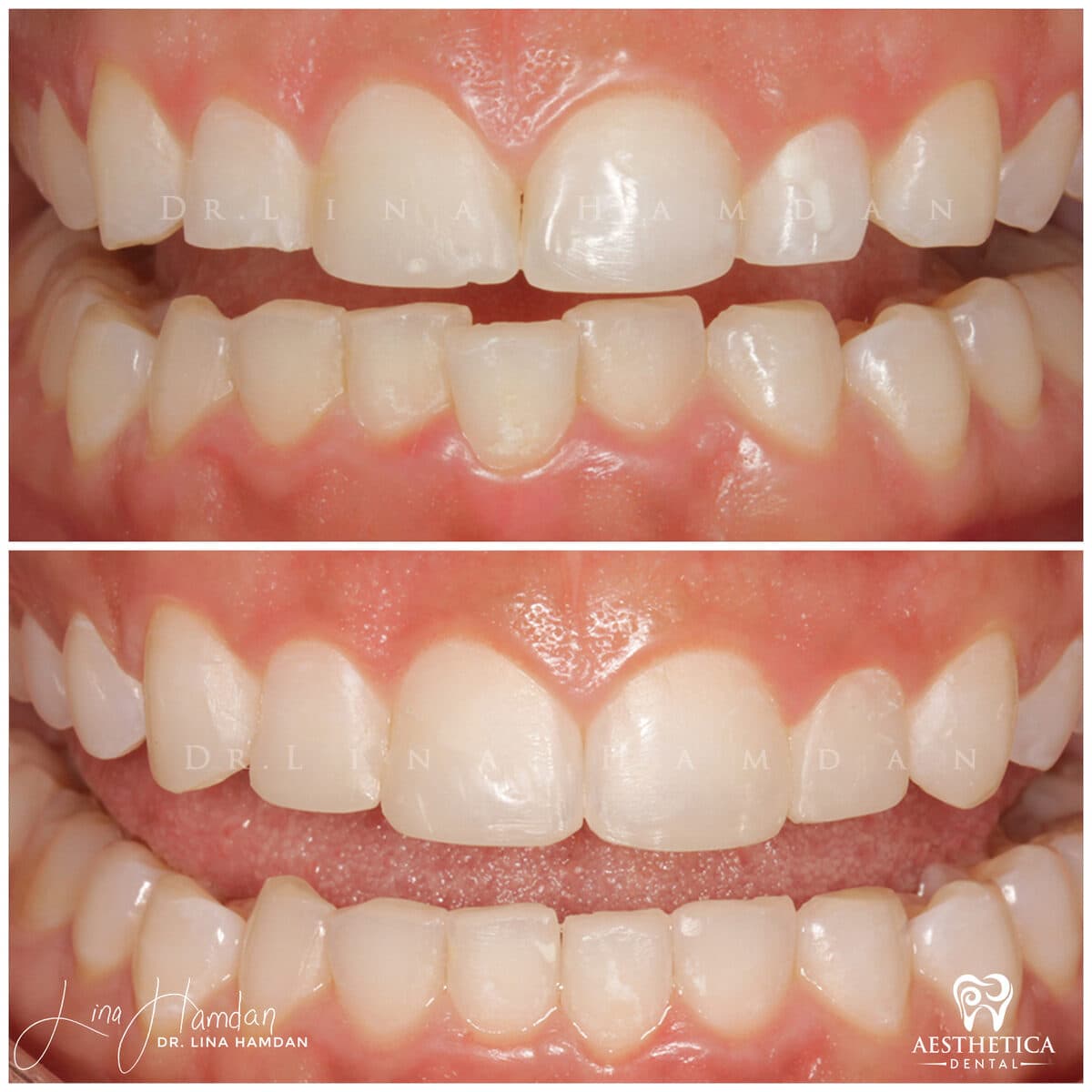 Inman aligners: anonymous case 15 from Aesthetica Dental Naperville