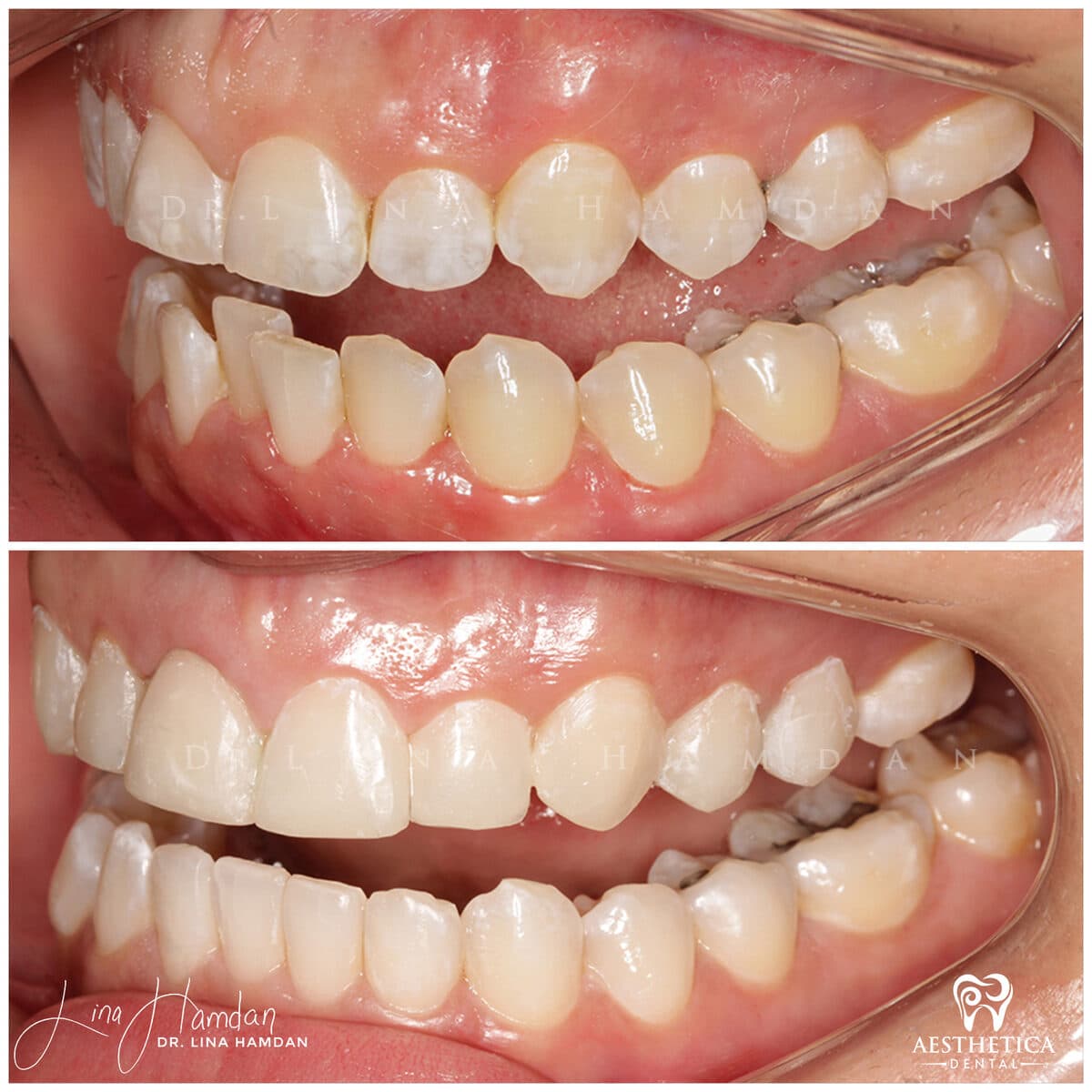 Inman aligners: anonymous case 18 from Aesthetica Dental Naperville