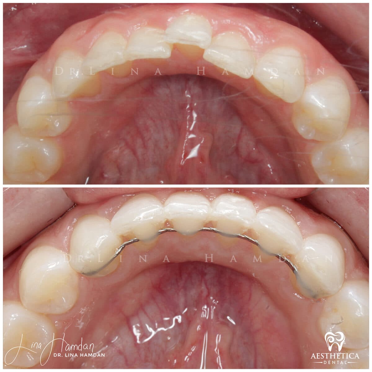 Inman aligners: anonymous case 19 from Aesthetica Dental Naperville