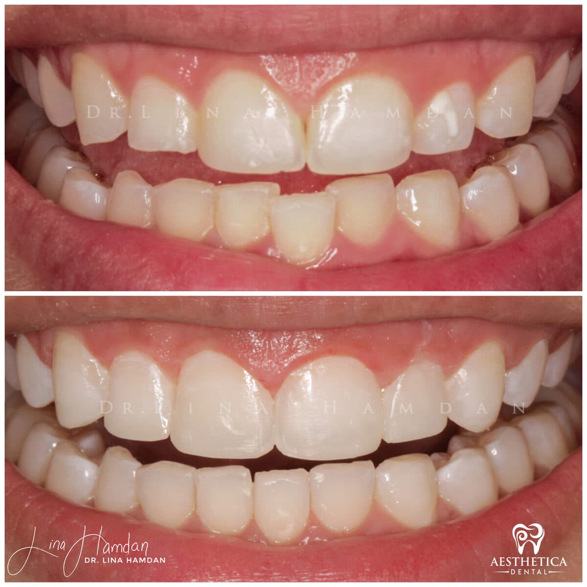 Inman aligners: anonymous case 24 from Aesthetica Dental Naperville