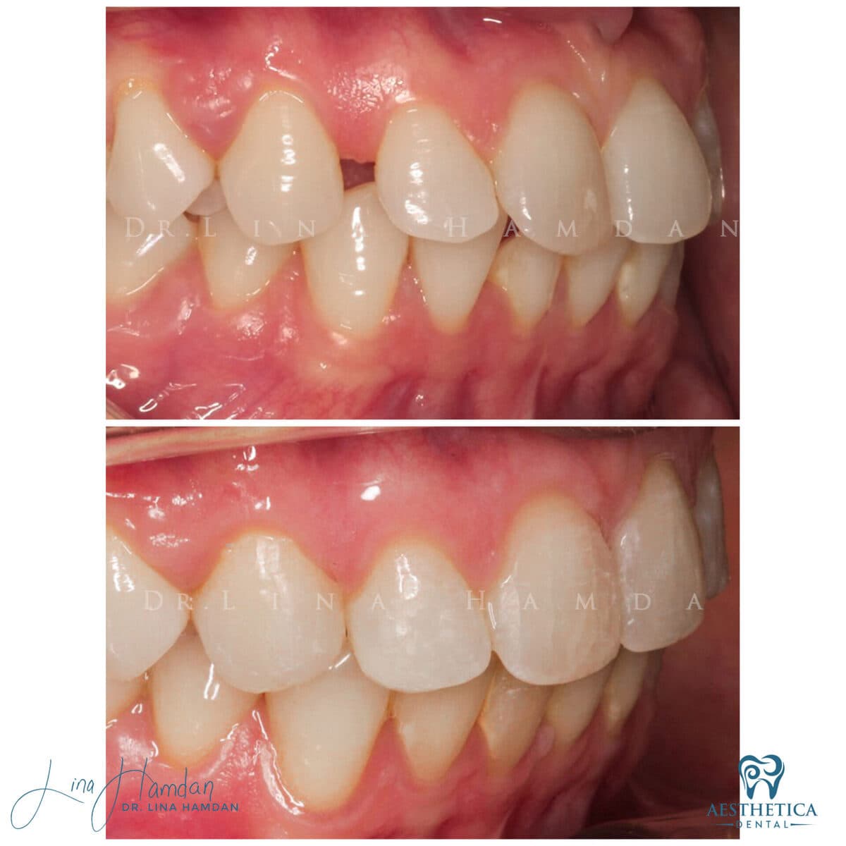 Inman aligners: anonymous case 26 from Aesthetica Dental Naperville