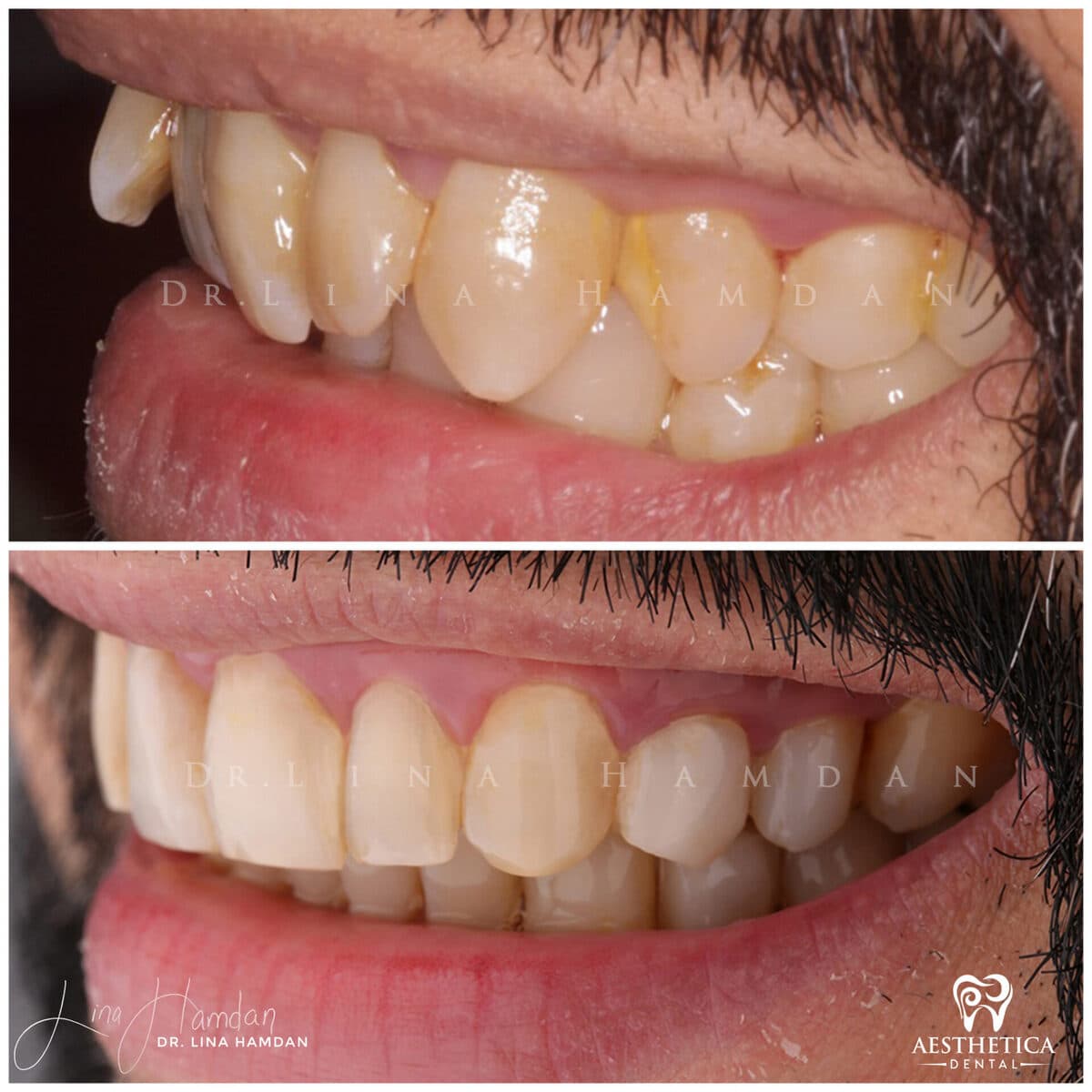 Inman aligners: anonymous case 29 from Aesthetica Dental Naperville