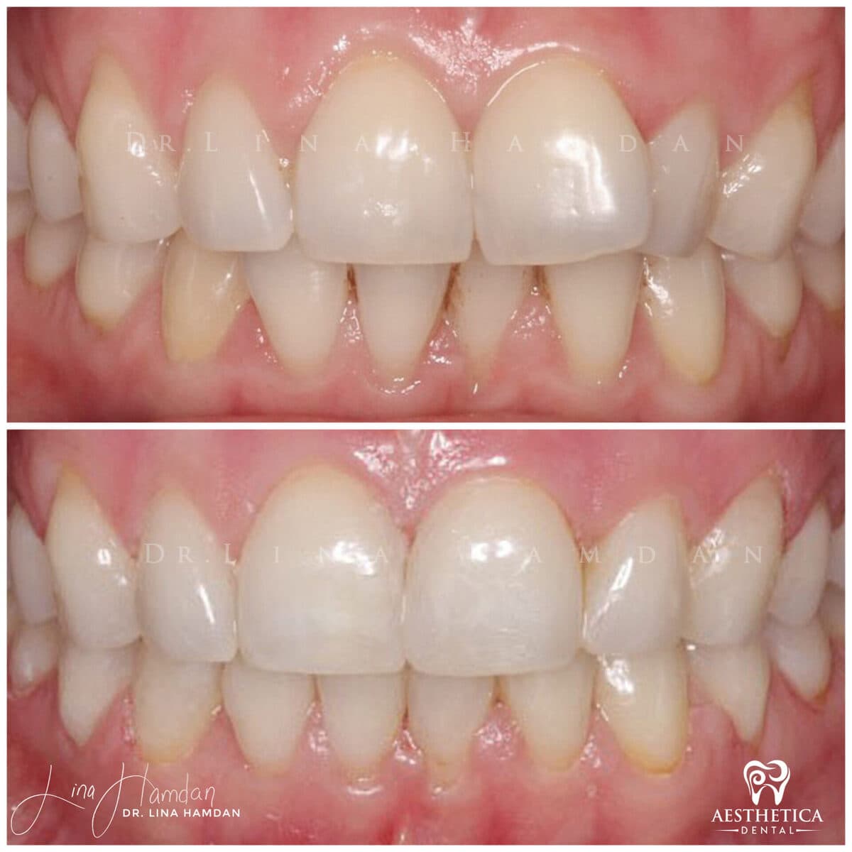 Inman aligners: anonymous case 30 from Aesthetica Dental Naperville
